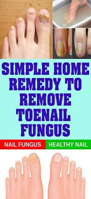 SIMPLE HOME REMEDY TO REMOVE TOENAIL FUNGUS