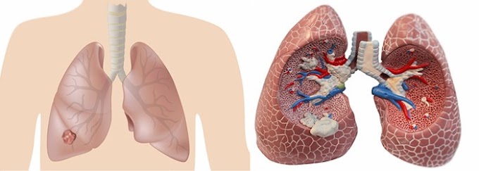 Cómo volver ‘curable’ un cáncer de pulmón ‘letal’: quimioinmunoterapia antes de cirugía