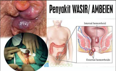 Cara Mengobati Ambeien Dengan Bahan Alami