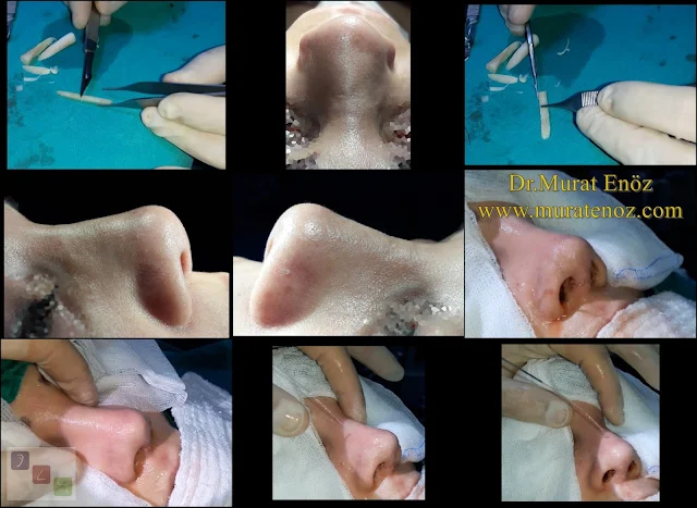 Revision rhinoplasty in Istanbul, Revision rhinoplasty Istanbul, Revision nose Job in Istanbul, Revision nose job in Turkey, Revision rhinoplasty with cadaveric rib cartilage - Revision nose job with irradiated rib cartilage - Costal cartilage in revision rhinoplasty