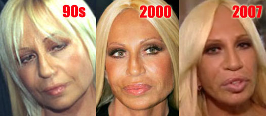 donatella versace before and after plastic surgery. Donatella Versace Plastic