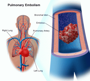 pulmonary artery, pulmonary fibrosis, pulmonary edema, signs pulmonary embolism, symptoms pulmonary embolism, pulmonary embolism definition, pulmonary embolism causes, pulmonary embolism cancer, pulmonary embolism ecg, pulmonary hypertension, treatment pulmonary embolism, acute pulmonary embolism, pulmonary embolism diagnosis, blood clot