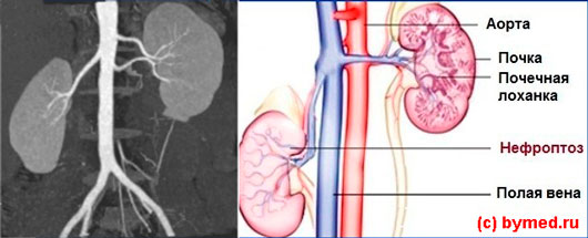 Нефроптоз