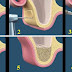 Nâng xoang hàm trong cấy ghép implant là gì ?