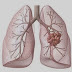 treatment of lung cancer