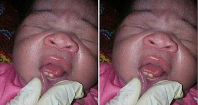 New Born baby with Teeth