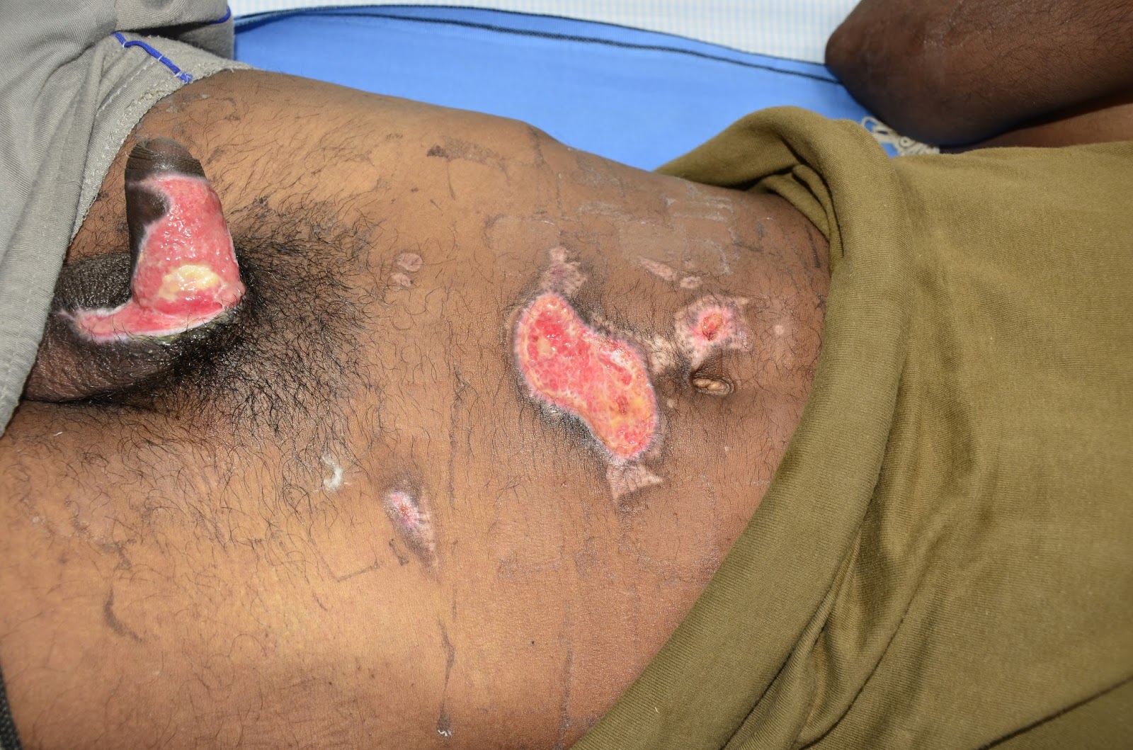 BURN INJURY , HAND BURNS, ELECTRICAL BURNS.: NEGLECTED ELECTRICAL BURN  WOUNDS OVER PENILE SHAFT AND LEFT HAND - OPEN PIP JOINT MIDDLE FINGER -  RECONSTRUCTION WITH GROIN FLAP, ABDOMINLA FLAP AND SKIN GRAFTING