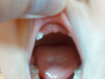 赤ちゃん 歯の生え始め 斜め 342670-赤ちゃん 歯の生え始め 斜め