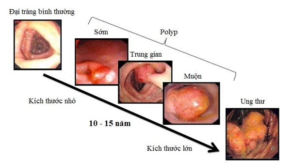 Hình 2. Quá trình tiến triển tự nhiên của polyp thành ung thư đại-trực tràng