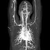 UPPER LIMB ANGIO