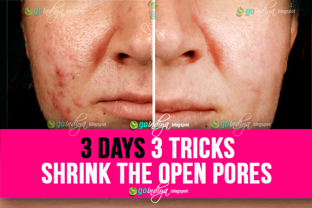 3 days 3 tricks! And all open pores will disappear from your skin forever