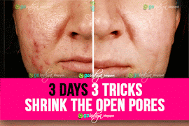 3 days 3 tricks! And all open pores will disappear from your skin forever