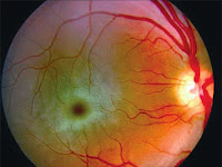 tay sachs disease diagnosis Tay sachs disease retina file 1629 imagebank
