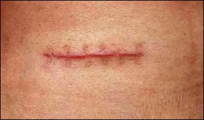 Rüyada Yara Görmek Ne Anlama Gelir?