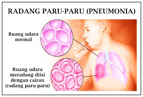 Cara Mengobati Radang Paru-Paru Herbal