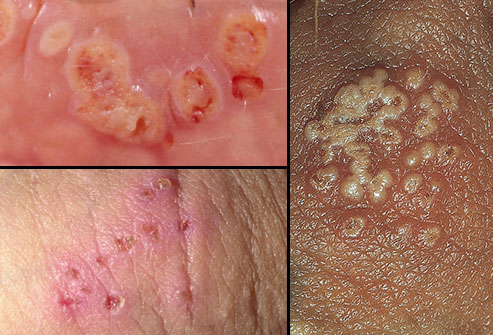 pengobatan herpes alami