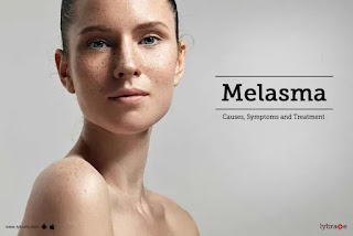 Melazma (Melasma) je čest, bezopasan kožni problem, koji uzrokuje tamne mrlje (hiperpigmentaciju) na licu. Obično je uzrokovana izlaganjem suncu. Kada se melazma pojavi kod trudnica, naziva se kloazma (Chloasma) ili "maska ​​trudnoće".