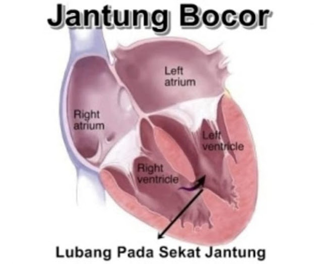 sakit jantung bocor