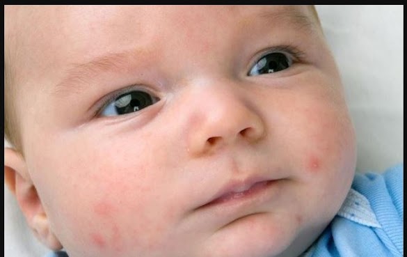 How to Get Rid of Baby Acne with Natural Ways