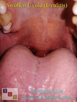 Swollen Uvula (Uvulitis)