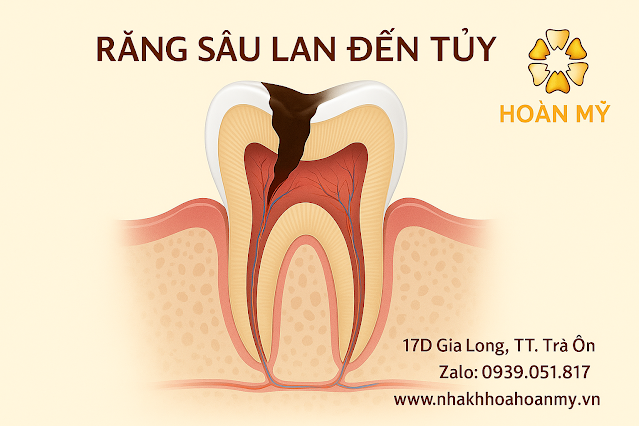 Điều trị tủy răng – Giải pháp bảo tồn răng đau nhức kéo dài tại Nha Khoa Hoàn Mỹ Sài Gòn – Trà Ôn