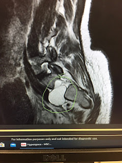 MRI image of a large cyst on my spine