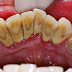 Tiến hành cạo vôi răng có lợi hay hại?