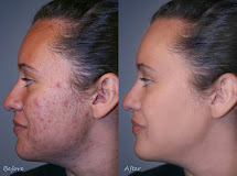 How to get rid of Acne,How to remove Pimple,Acne vulgeris,blackheads,whiteheads,comedo