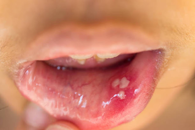 Canker Sores 101 – 2023