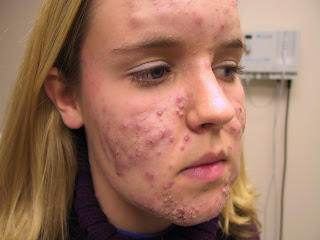 Resultado de imagen para acne en adolescentes