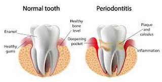 A comparison image between a healthy tooth and a tooth with gum disease picture