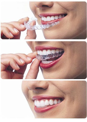 nieng-rang-invisalign