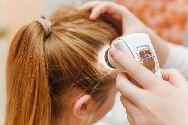 Low light laser therapy for hair loss