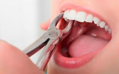 Nhổ răng có ảnh hưởng gì không