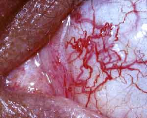 telangiectasia  ialah kekacauan keturunan yang ditandai dengan tidak ada koordinasi Ataxia-Telangiectasia