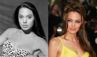 Angelina Jolie Rhinoplasty (Nose Job)