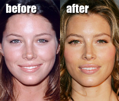 Lip Plastic Surgery Before And After
