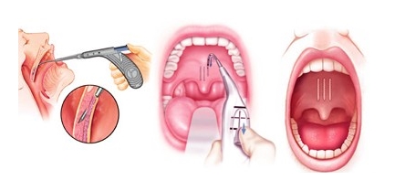 Pillar Implant Horlama Tedavisi - Damak İmplantı