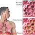 Kenali 3 Penyebab Paru-paru Basah (Pneumonia)