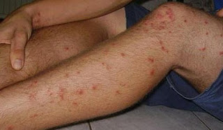 Obat Penyakit Herpes Pada Kaki