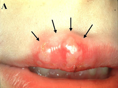 herpes sores on tongue. genital herpes mouth.