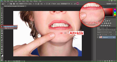 menghilangkan jerawat dengan bantuan software