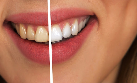 teeth-whitening-in-gurgaon-at-modern-dental-centre