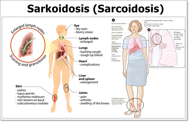  lokasi dan luasnya penyakit, tetapi gejala umum sarkoidosis meliputi