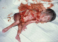 Aborted Baby