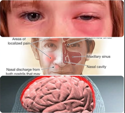 Gejala dan Ubat - Ubatan Untuk Sinusitis Yang Berbahaya 