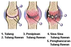 gambar pengapuran sendi osteoartritis