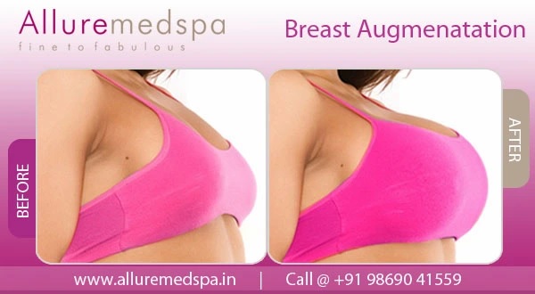 Breast Implant Surgery Before and After