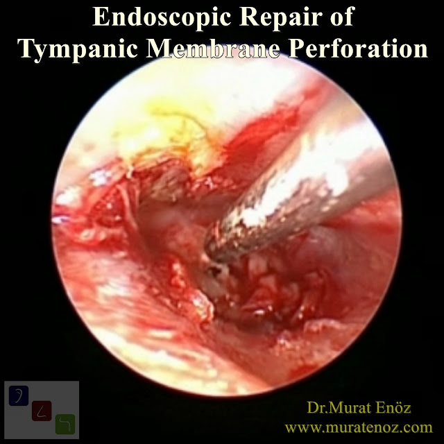 Endoscopic Eardrum Repair - Endoscopic Repair of Tympanic Membrane Perforation - Transcanal Endoscopic Myringoplasty - Endoscope Assisted Myringoplasty - Endoscopic Myringoplasty - Endoscopic-Assisted Myringoplasty - Endoscopic Eardrum Hole Surgery