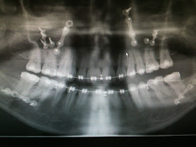 Temporamandibular TMJD jaw operation